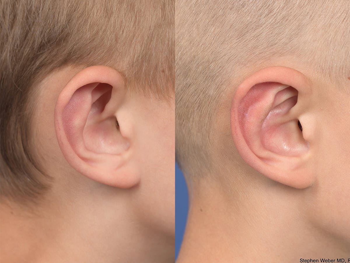 Otoplasty Before & After Gallery - Patient 556984 - Image 6
