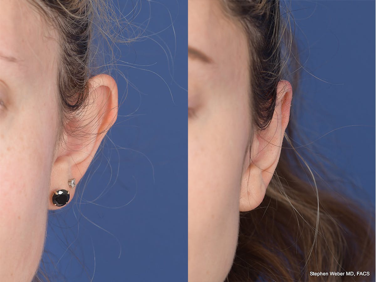 Otoplasty Before & After Gallery - Patient 223638 - Image 1