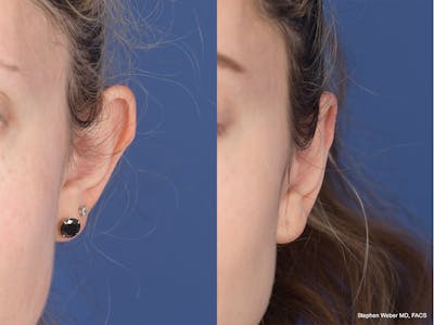 Otoplasty Before & After Gallery - Patient 223638 - Image 1