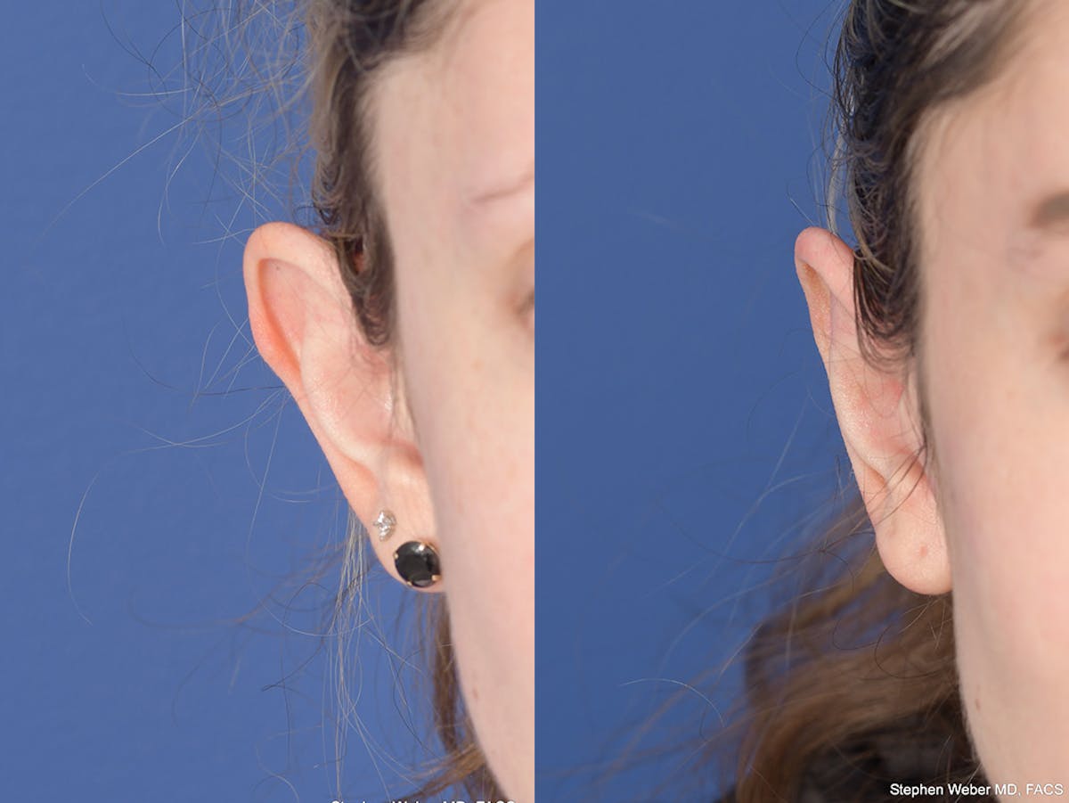 Otoplasty Before & After Gallery - Patient 223638 - Image 2