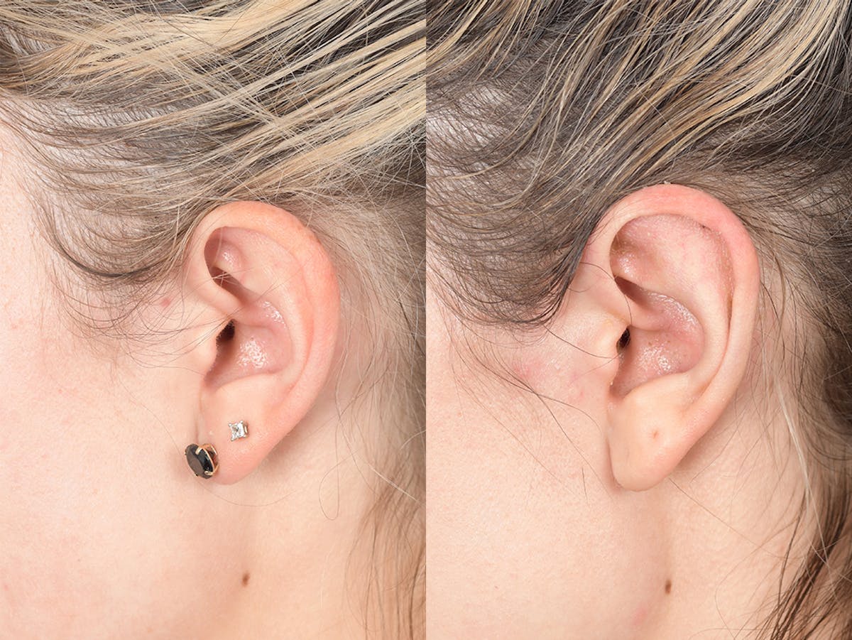 Otoplasty Before & After Gallery - Patient 223638 - Image 3