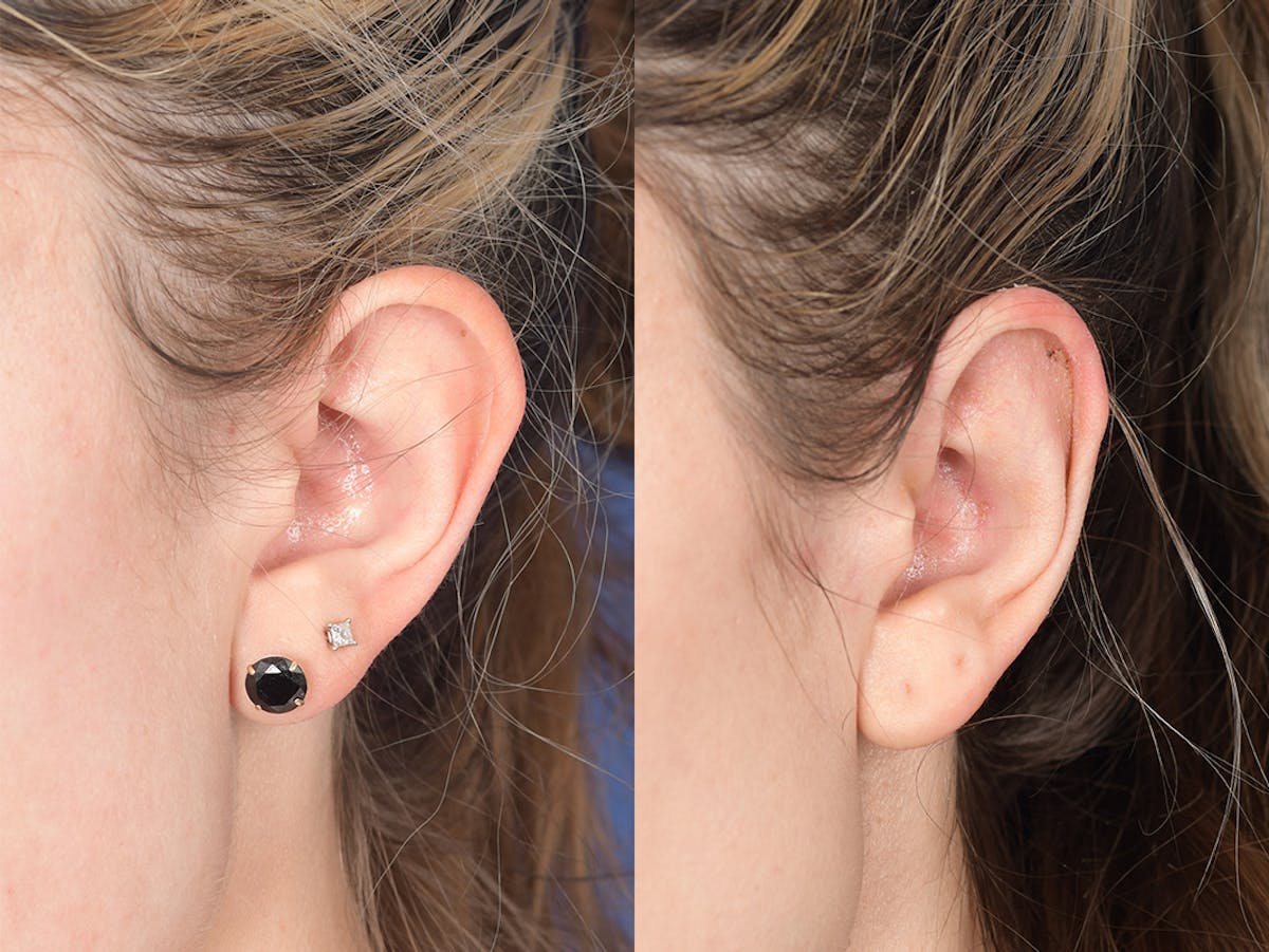 Otoplasty Before & After Gallery - Patient 223638 - Image 4