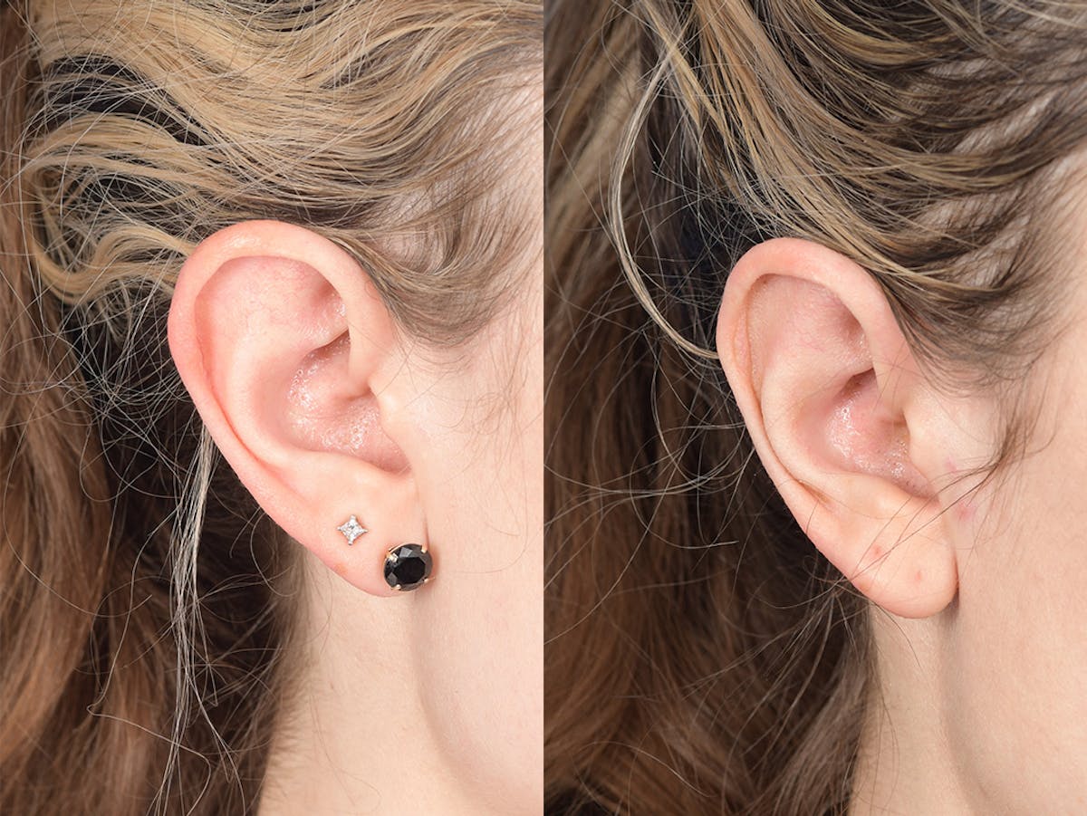 Otoplasty Before & After Gallery - Patient 223638 - Image 5