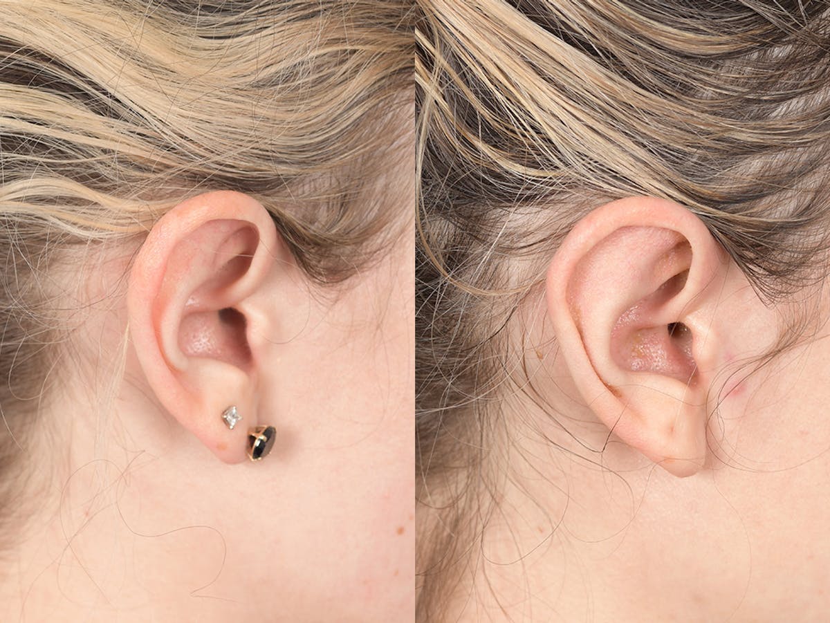 Otoplasty Before & After Gallery - Patient 223638 - Image 6