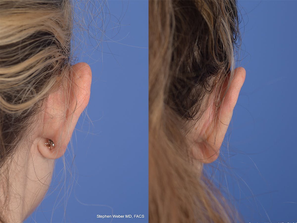Otoplasty Before & After Gallery - Patient 223638 - Image 7