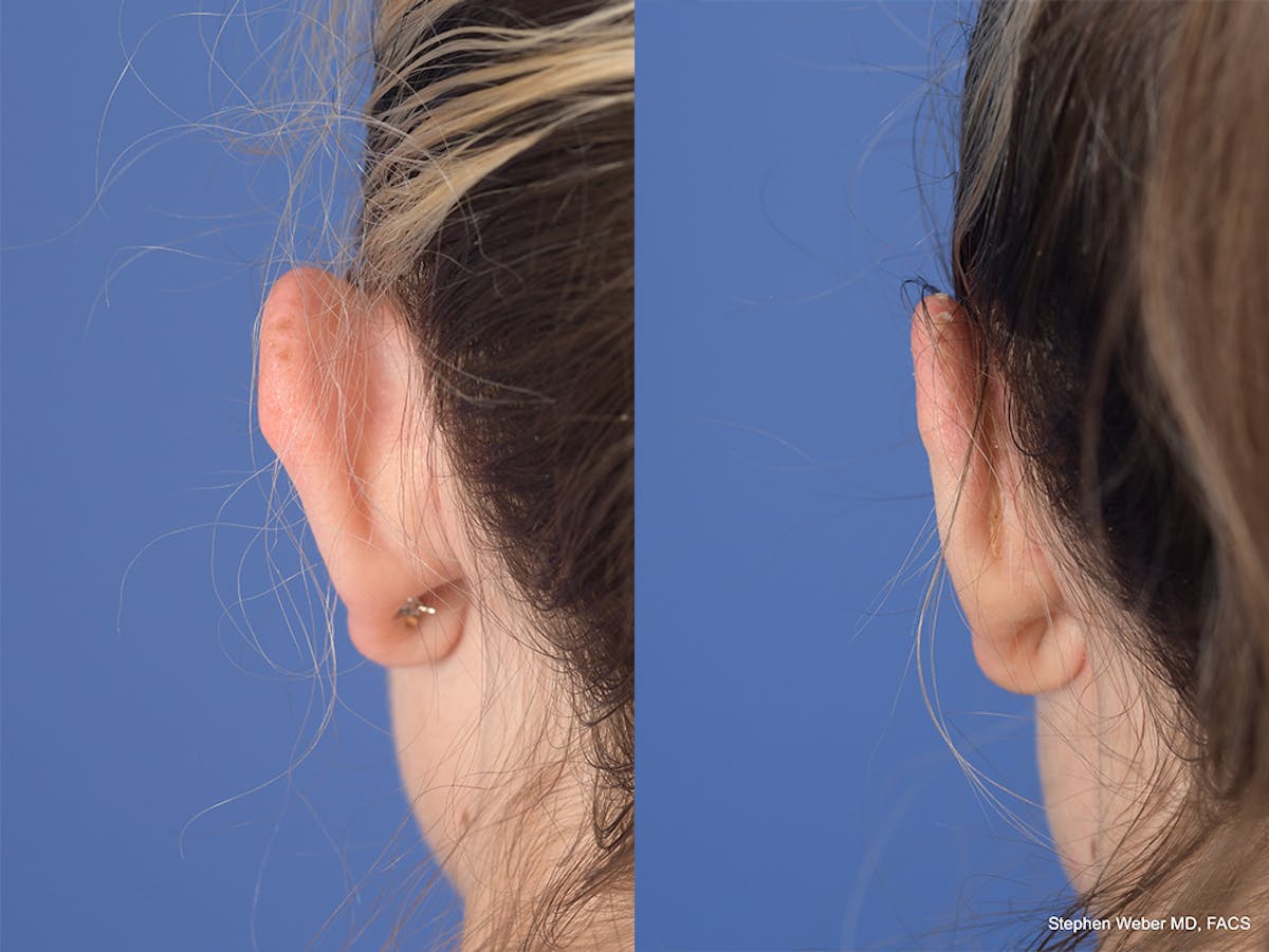 Otoplasty Before & After Gallery - Patient 223638 - Image 8