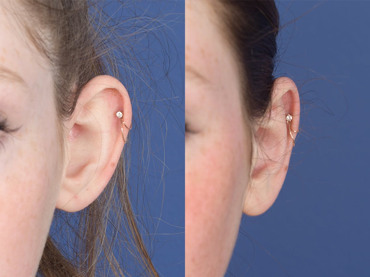Otoplasty Before & After Gallery - Patient 846129 - Image 1