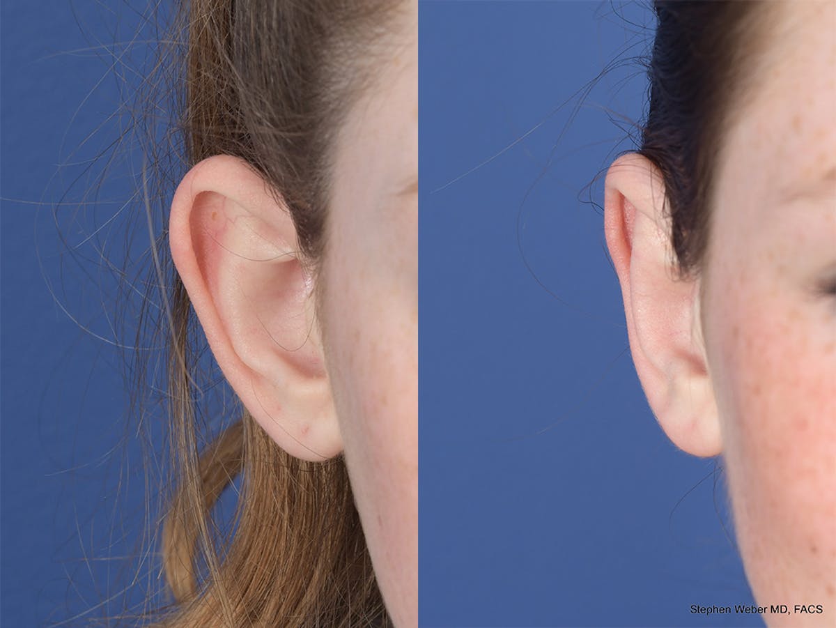 Otoplasty Before & After Gallery - Patient 846129 - Image 2