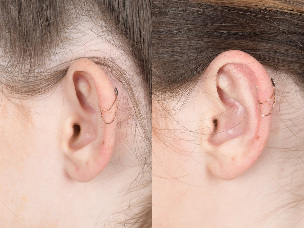 Otoplasty Before & After Gallery - Patient 846129 - Image 3