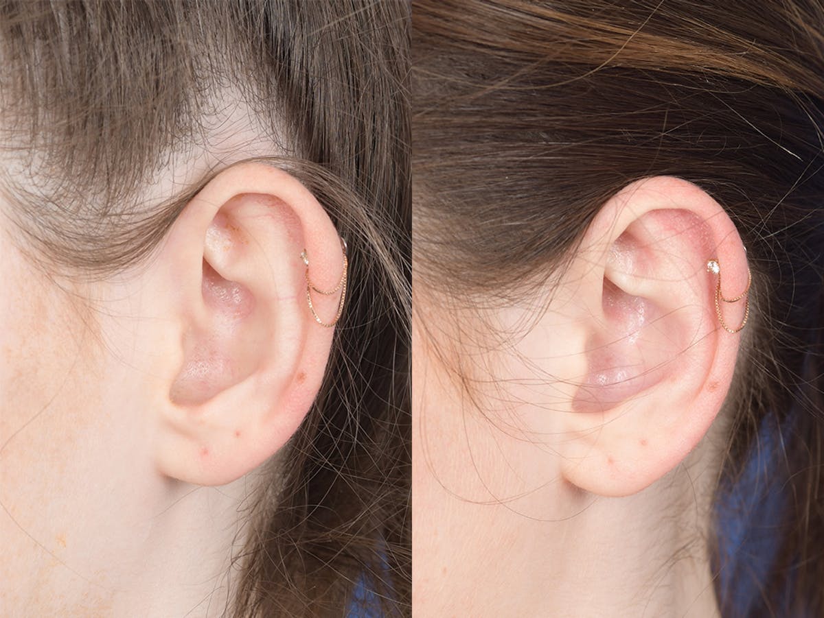 Otoplasty Before & After Gallery - Patient 846129 - Image 4