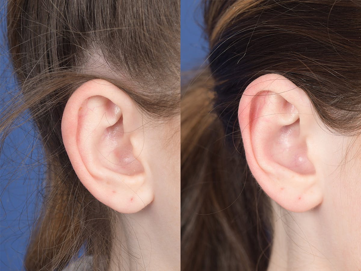 Otoplasty Before & After Gallery - Patient 846129 - Image 5