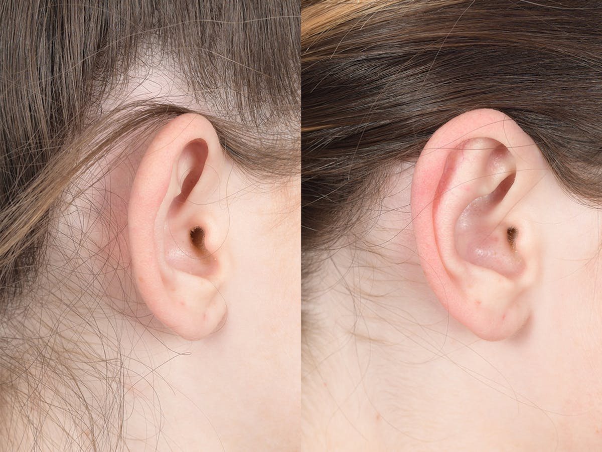 Otoplasty Before & After Gallery - Patient 846129 - Image 6