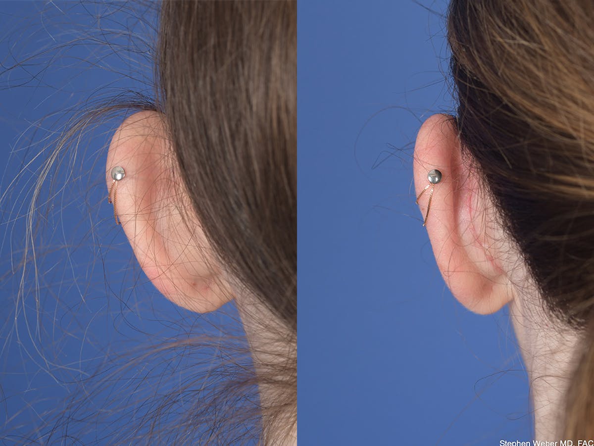 Otoplasty Before & After Gallery - Patient 846129 - Image 7