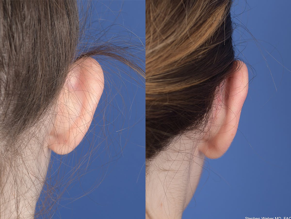 Otoplasty Before & After Gallery - Patient 846129 - Image 8