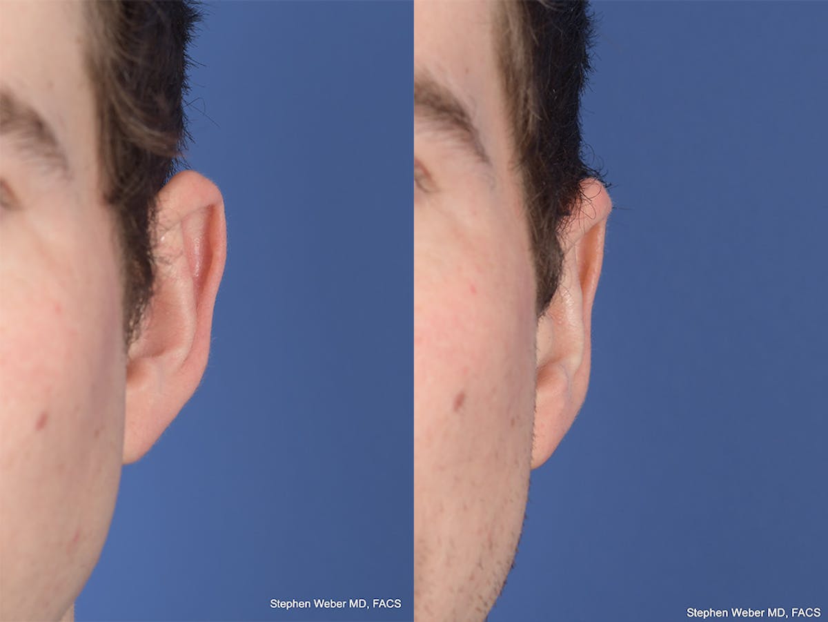 Otoplasty Before & After Gallery - Patient 100148 - Image 1