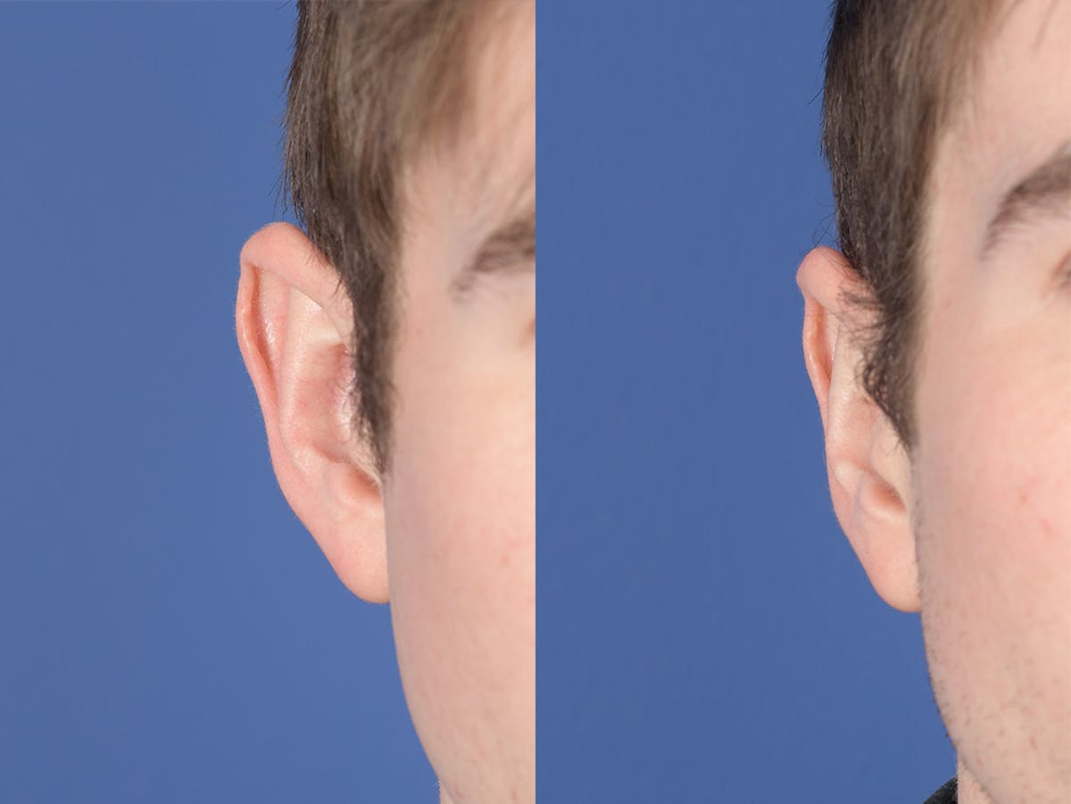 Otoplasty Before & After Gallery - Patient 100148 - Image 2