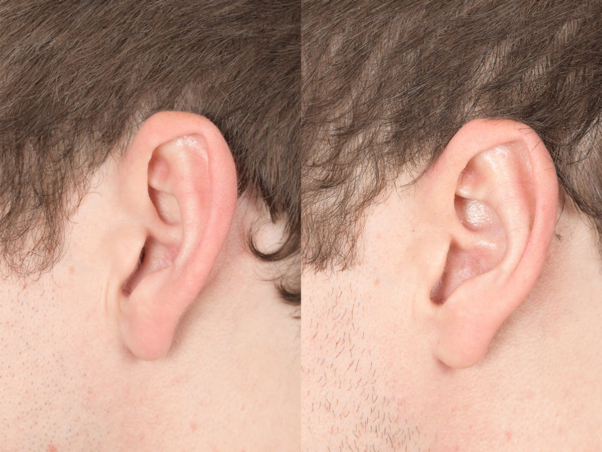Otoplasty Before & After Gallery - Patient 100148 - Image 3