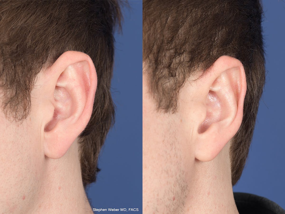 Otoplasty Before & After Gallery - Patient 100148 - Image 4