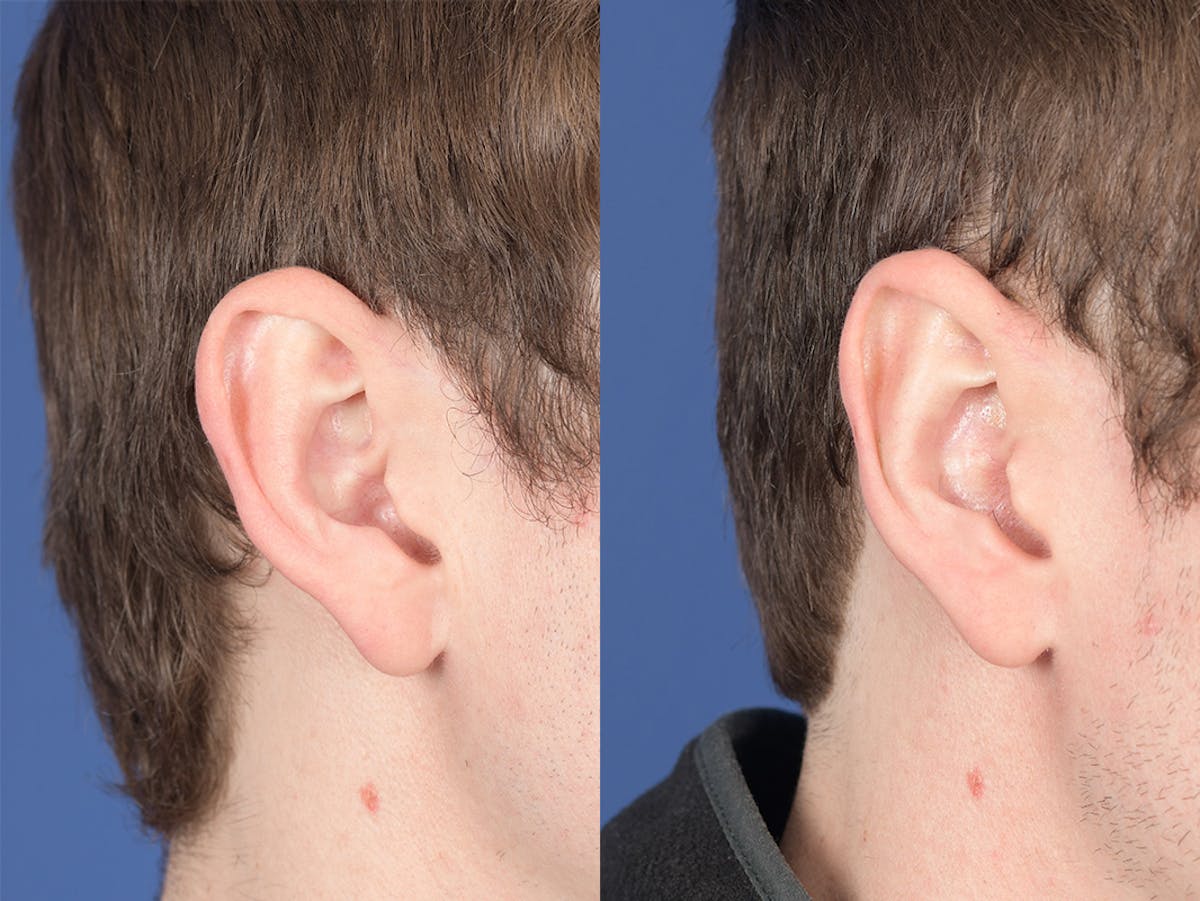 Otoplasty Before & After Gallery - Patient 100148 - Image 5