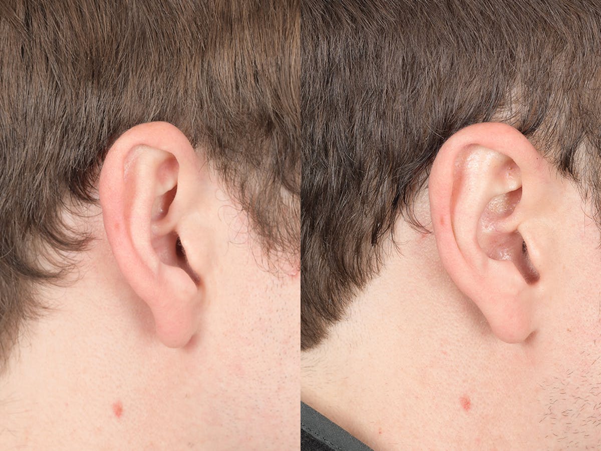 Otoplasty Before & After Gallery - Patient 100148 - Image 6