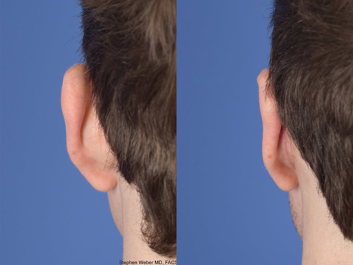 Otoplasty Before & After Gallery - Patient 100148 - Image 7