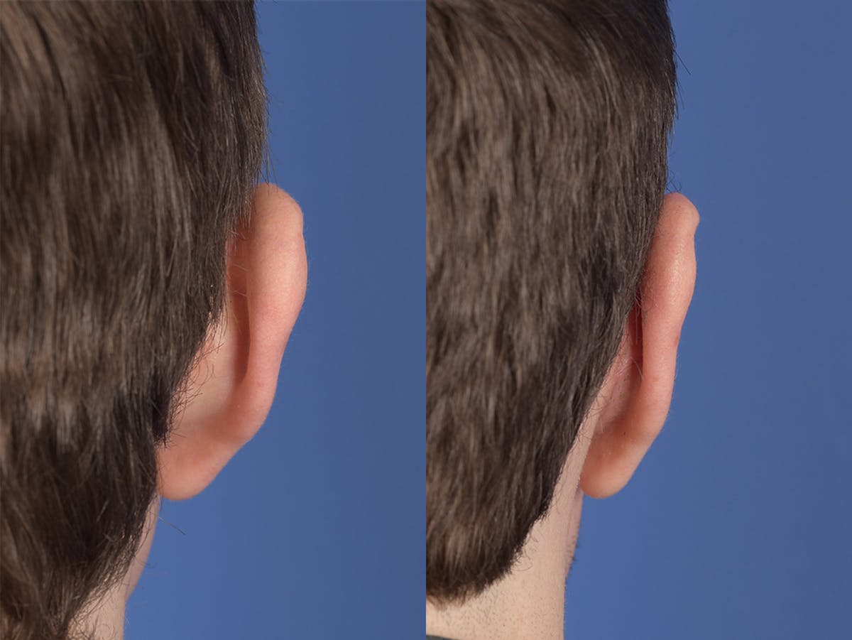 Otoplasty Before & After Gallery - Patient 100148 - Image 8