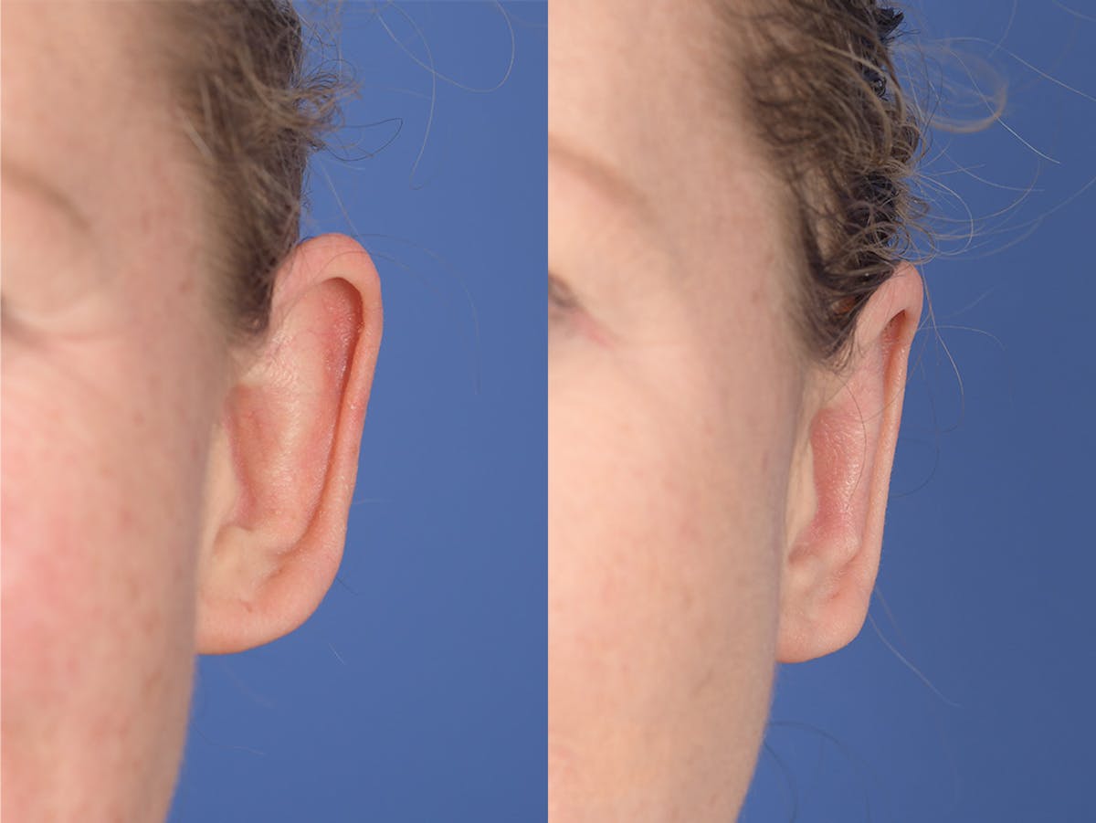 Otoplasty Before & After Gallery - Patient 167309 - Image 1