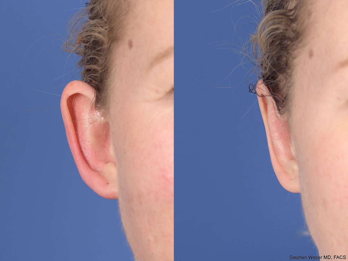Otoplasty Before & After Gallery - Patient 167309 - Image 2