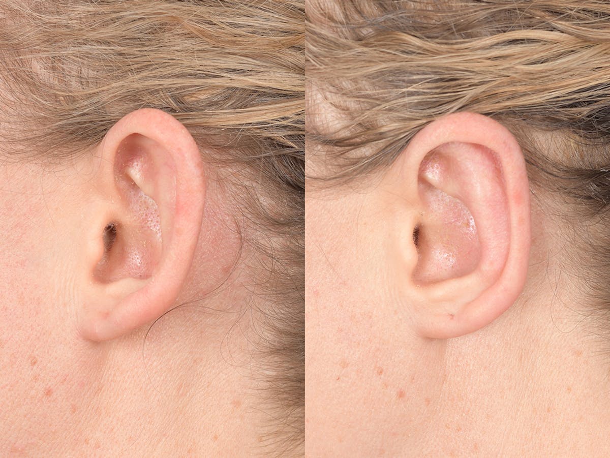 Otoplasty Before & After Gallery - Patient 167309 - Image 3