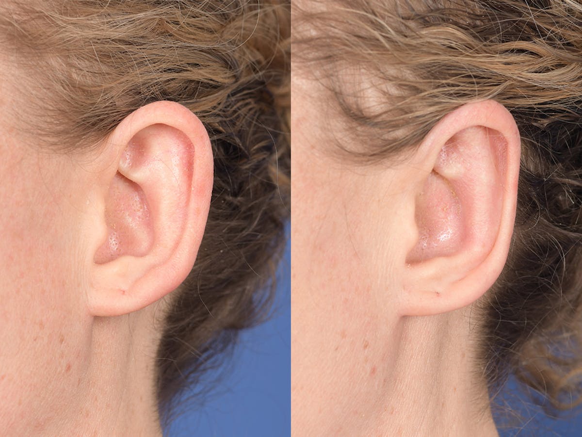 Otoplasty Before & After Gallery - Patient 167309 - Image 4