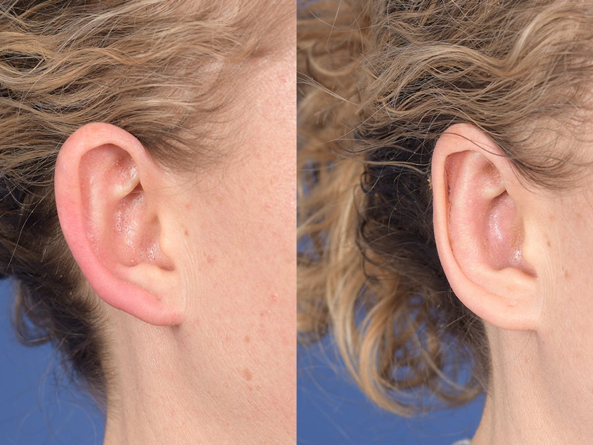 Otoplasty Before & After Gallery - Patient 167309 - Image 5