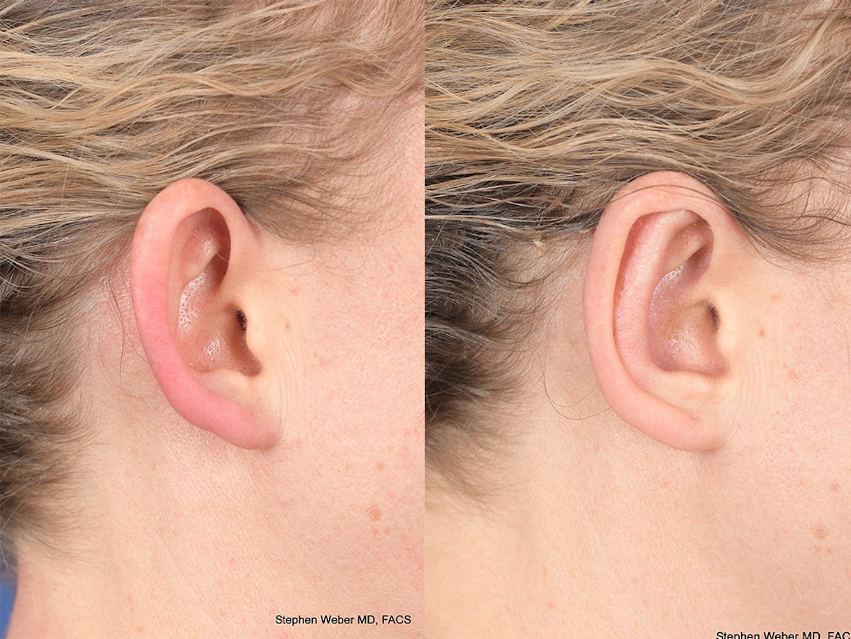 Otoplasty Before & After Gallery - Patient 167309 - Image 6