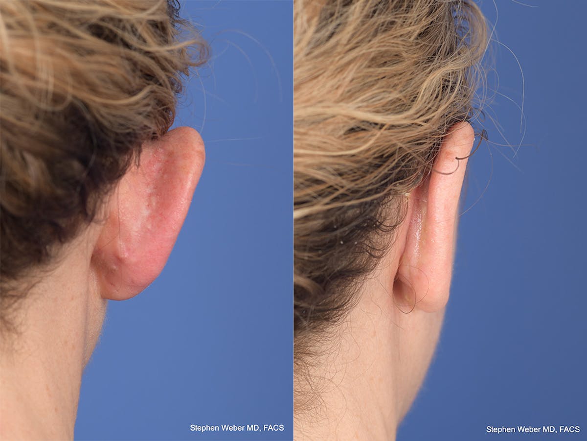 Otoplasty Before & After Gallery - Patient 167309 - Image 7