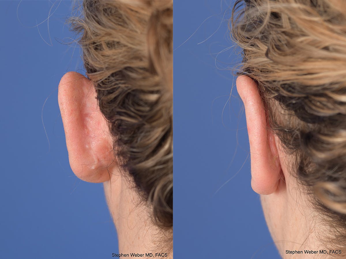 Otoplasty Before & After Gallery - Patient 167309 - Image 8