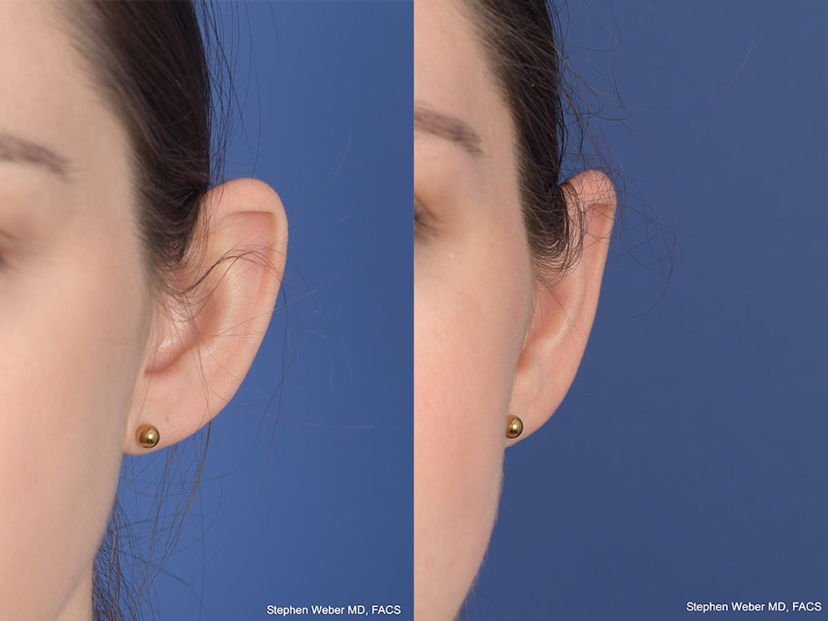 Otoplasty Before & After Gallery - Patient 199021 - Image 1