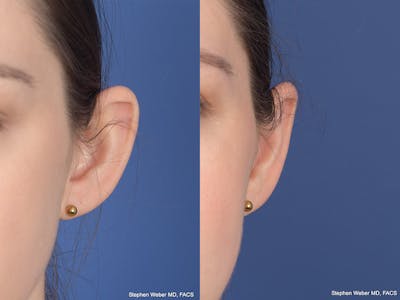 Otoplasty Before & After Gallery - Patient 199021 - Image 1