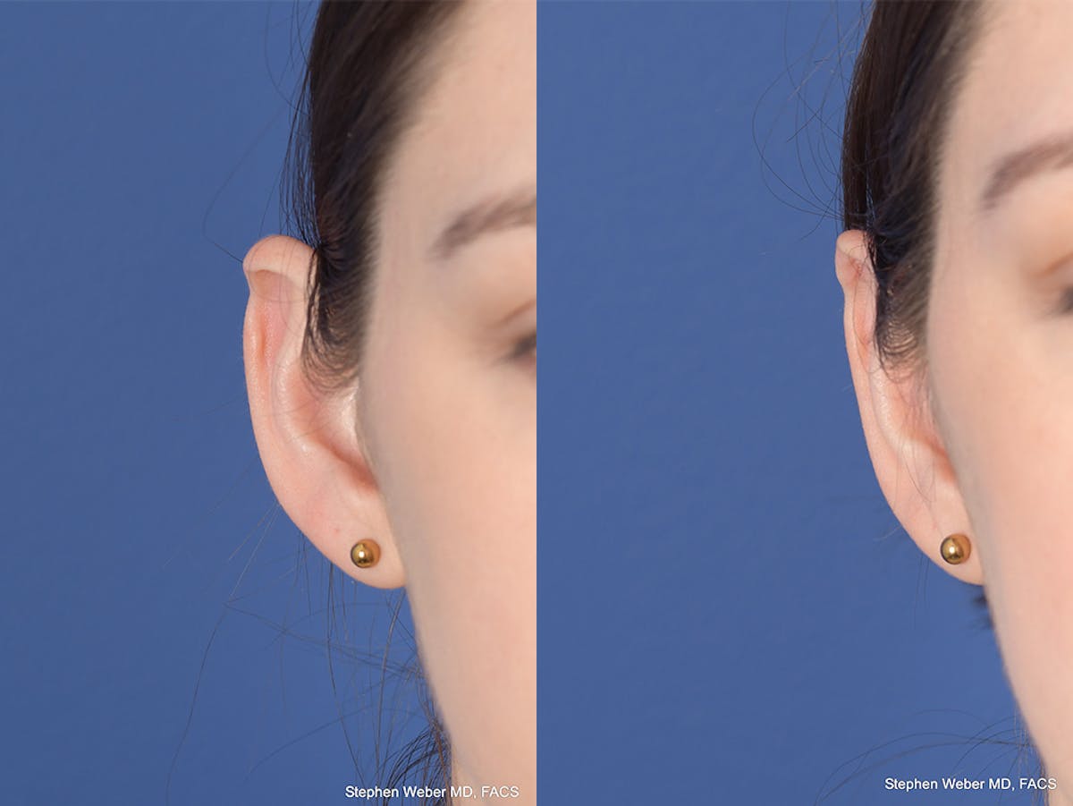 Otoplasty Before & After Gallery - Patient 199021 - Image 2