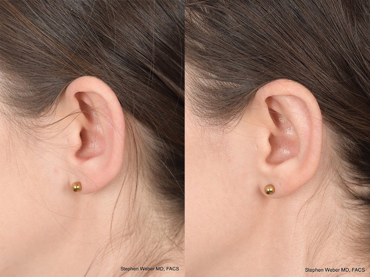Otoplasty Before & After Gallery - Patient 199021 - Image 3