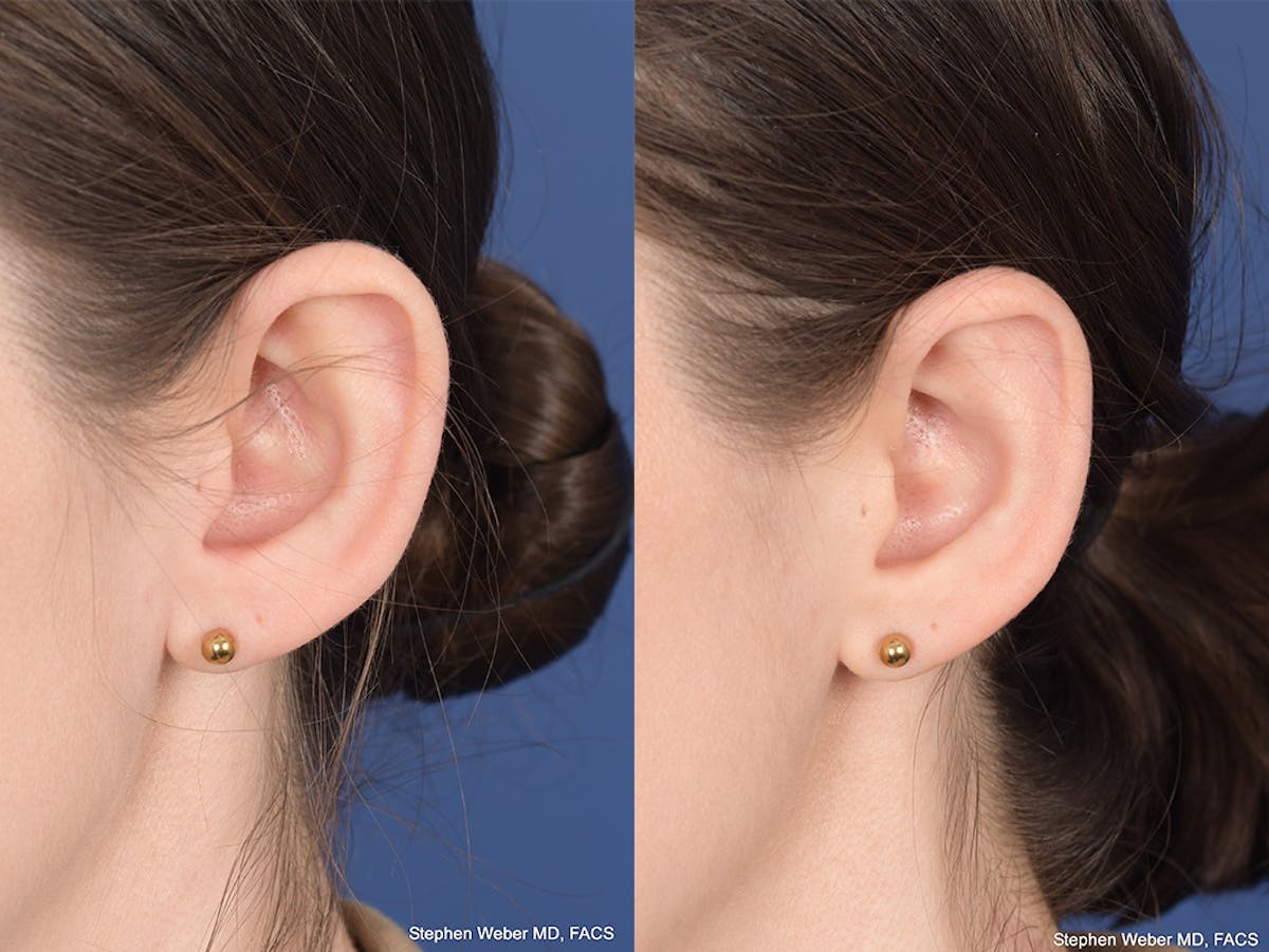 Otoplasty Before & After Gallery - Patient 199021 - Image 4