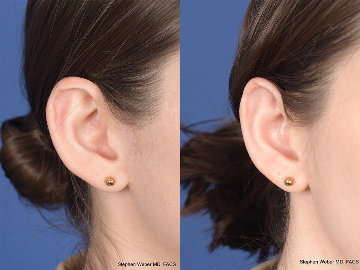 Otoplasty Before & After Gallery - Patient 199021 - Image 5