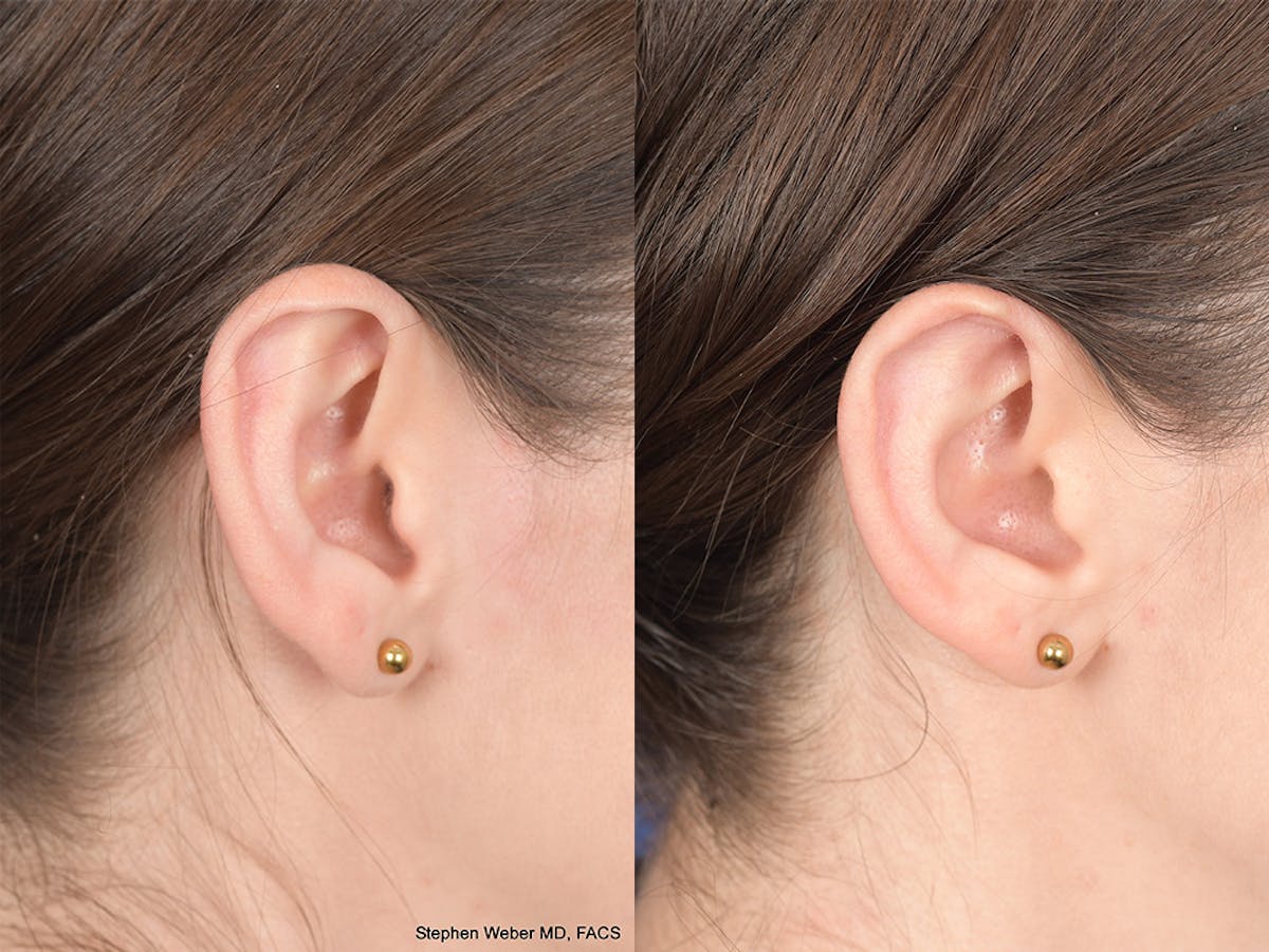 Otoplasty Before & After Gallery - Patient 199021 - Image 6
