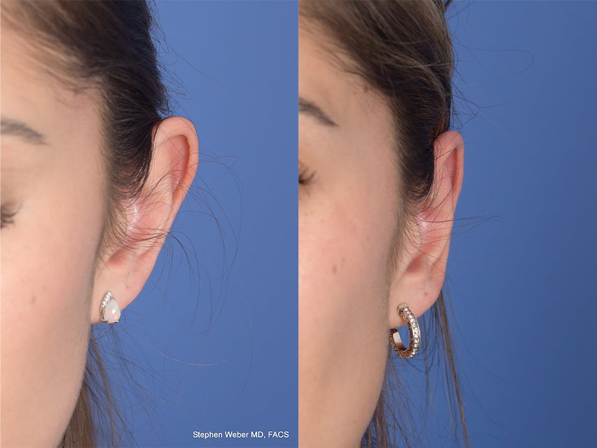 Otoplasty Before & After Gallery - Patient 309958 - Image 1