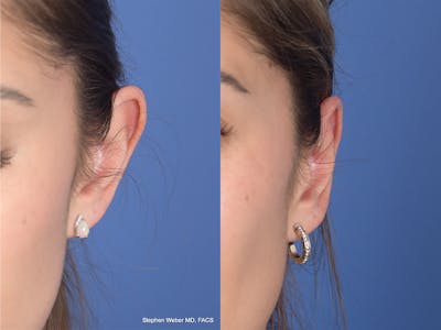 Otoplasty Before & After Gallery - Patient 309958 - Image 1