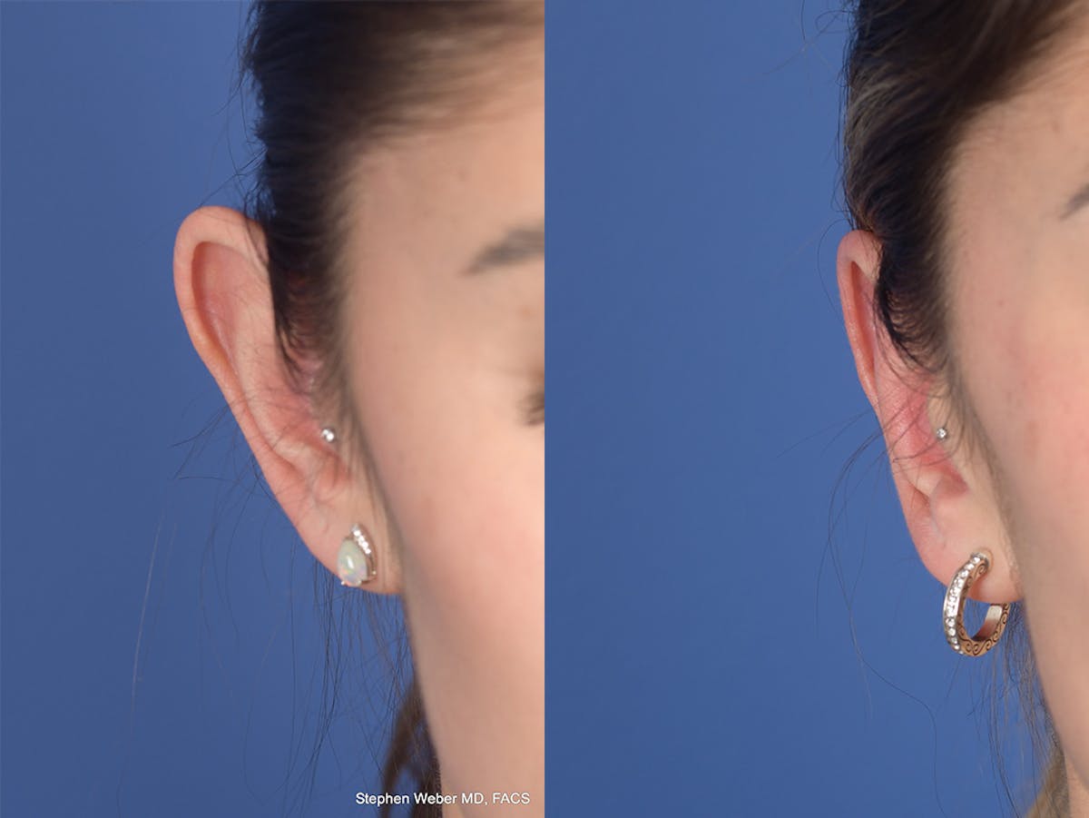 Otoplasty Before & After Gallery - Patient 309958 - Image 2