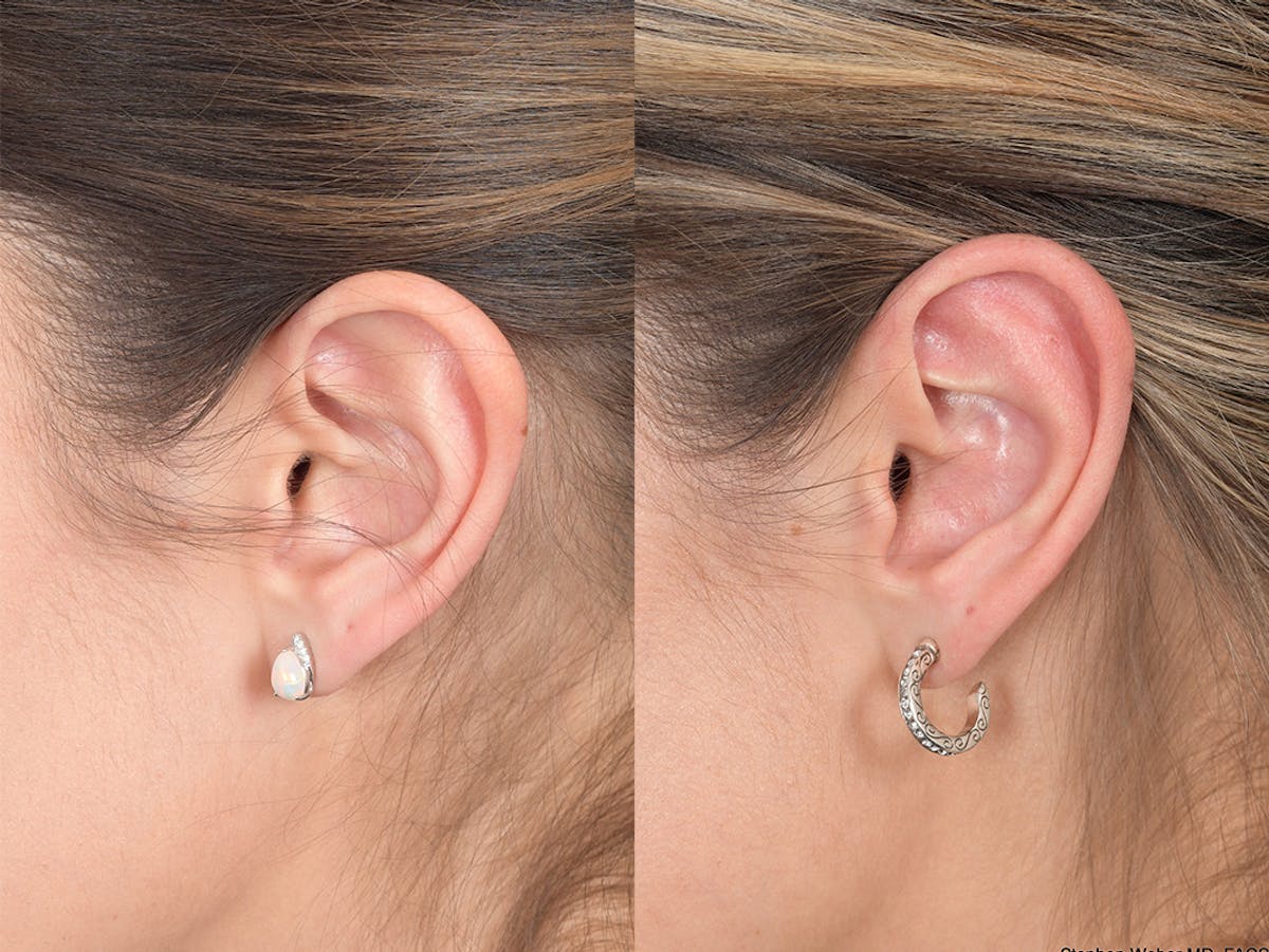 Otoplasty Before & After Gallery - Patient 309958 - Image 3