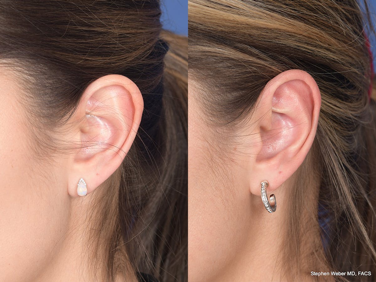 Otoplasty Before & After Gallery - Patient 309958 - Image 4