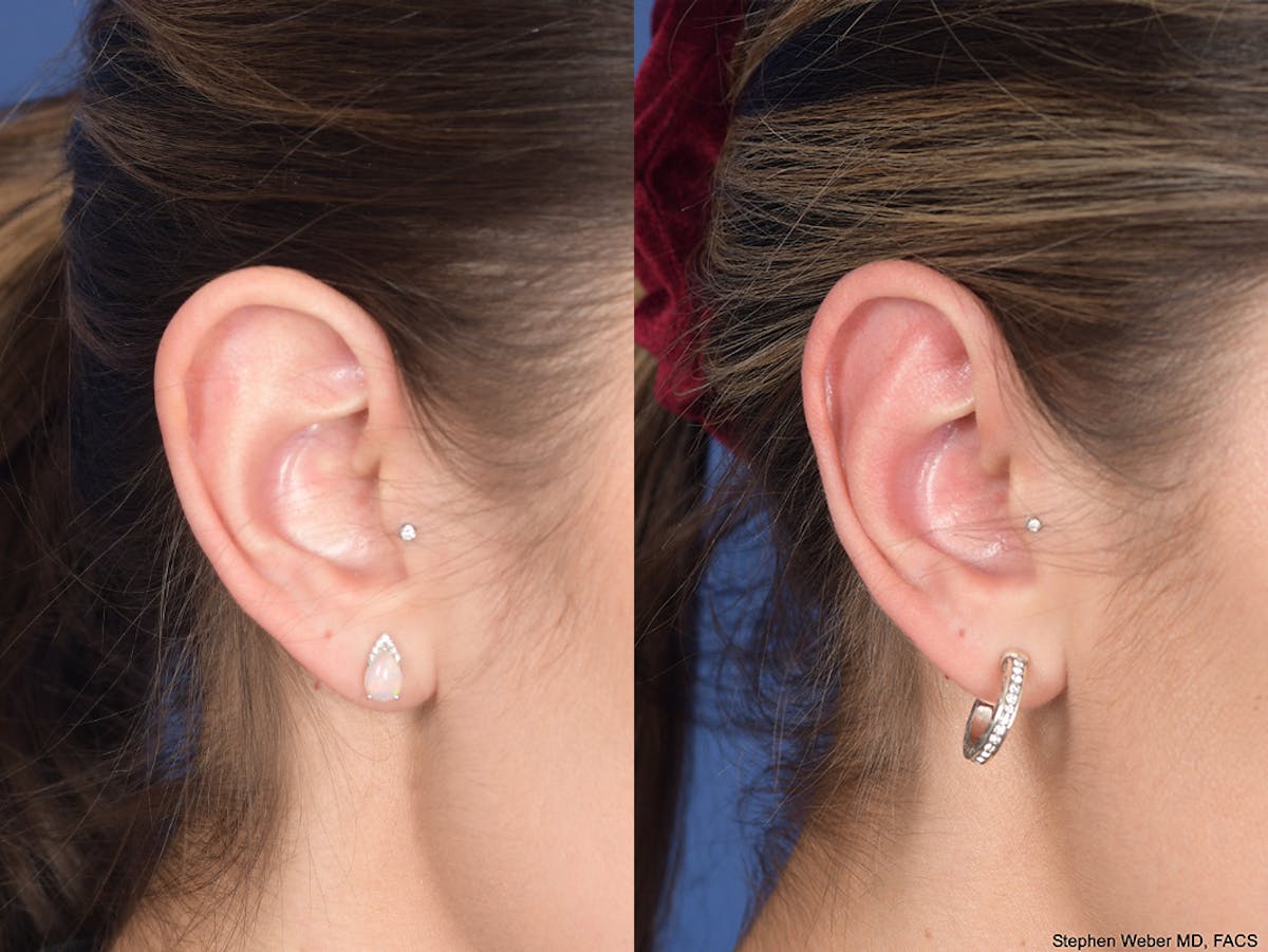 Otoplasty Before & After Gallery - Patient 309958 - Image 5