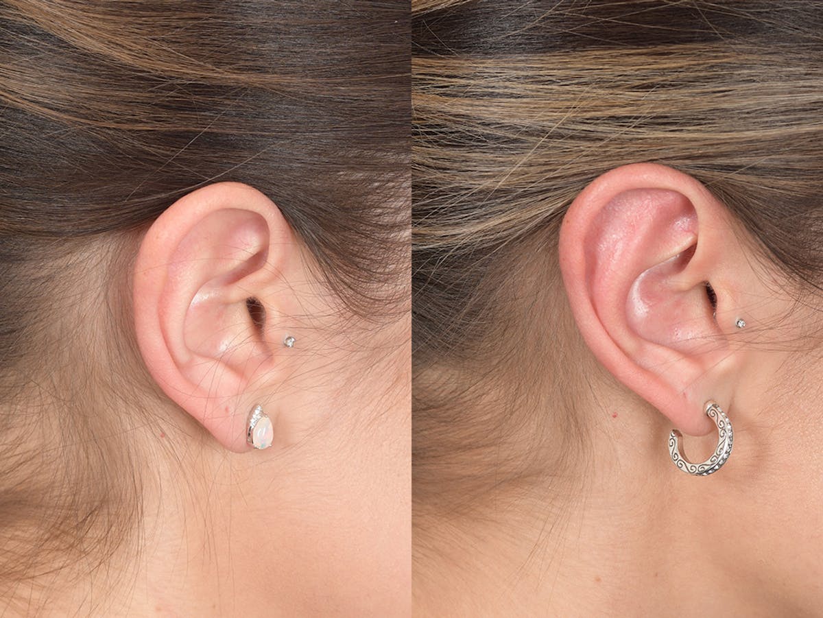 Otoplasty Before & After Gallery - Patient 309958 - Image 6