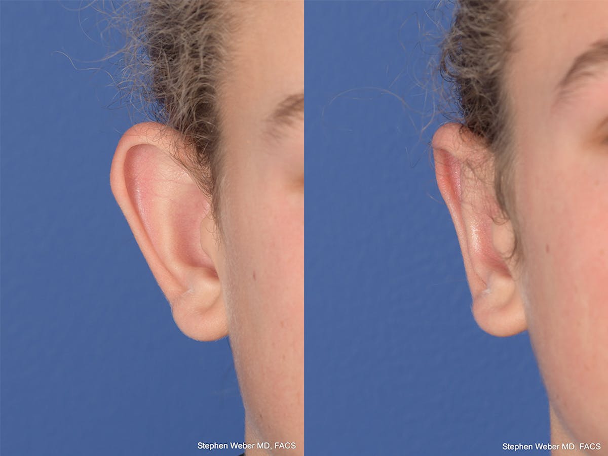 Otoplasty Before & After Gallery - Patient 288731 - Image 1