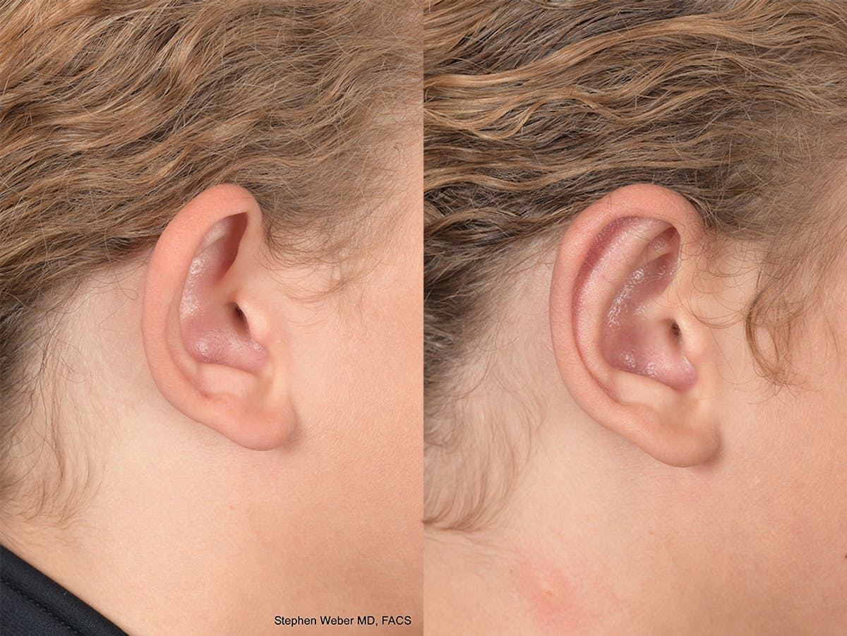 Otoplasty Before & After Gallery - Patient 288731 - Image 2
